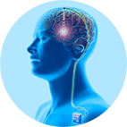  ﻿﻿Estimulação Cerebral Profunda ﻿ Deep Brain Stimulation (DBS)