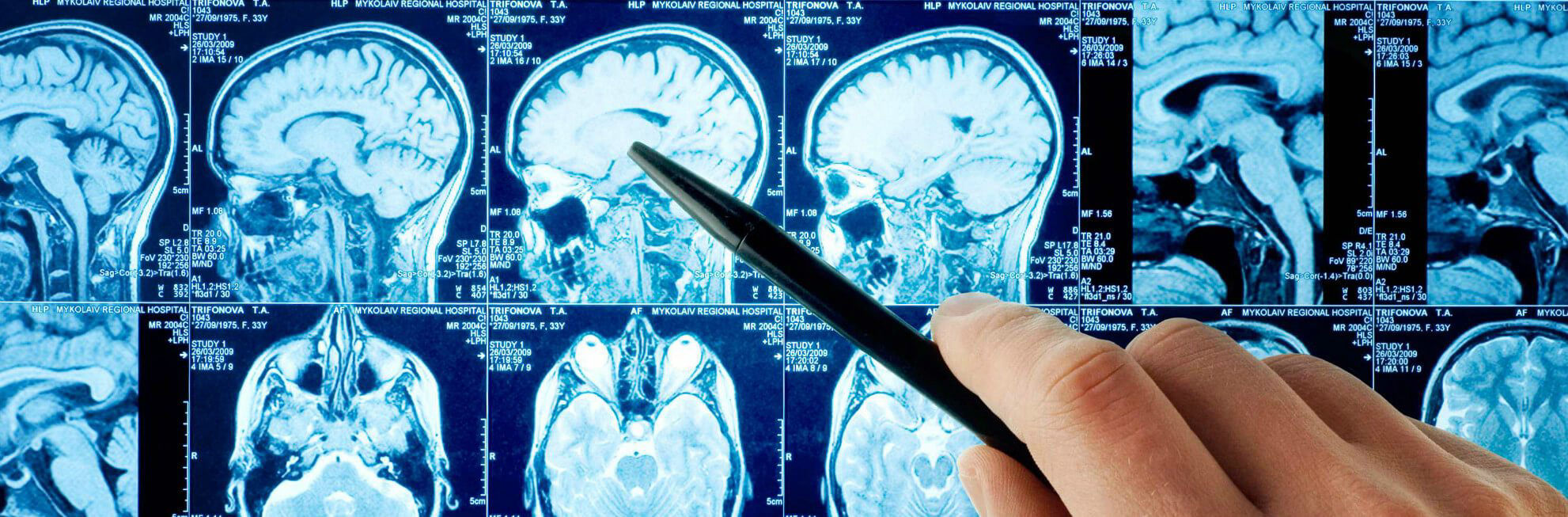 estimulação cerebral profunda